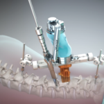 Robotic Spine Surgery For Maximum Improvement And Accuracy